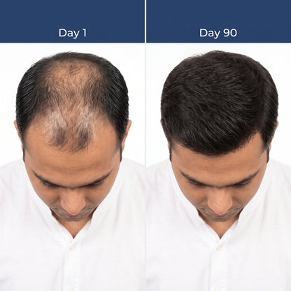 Deoxyline™ | Reverse Hairloss in 90 days - Triple Roll-On Serum