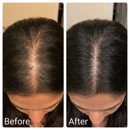 Deoxyline™ | Reverse Hairloss in 90 days - Triple Roll-On Serum