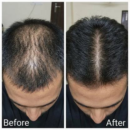 Deoxyline™ | Reverse Hairloss in 90 days - Triple Roll-On Serum
